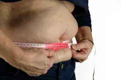Estabilización de la obesidad en España contrasta con su aumento en América Latina y África
